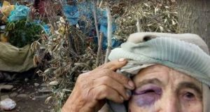 Μεσολόγγι: Το πρόσωπο της 86χρονης μαρτυρά την επίθεση που δέχθηκε