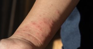 Κουνούπια: Το κόλπο πριν βγείτε έξω για να μην σας…