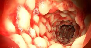 Αγρίνιο – Hμερίδα με θέμα: «Νόσος του Crohn και Ελκώδη…
