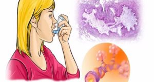 Βρογχικό άσθμα: Αίτια και διάγνωση