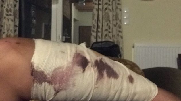 Τραυματισμός συμπολίτη μας από επίθεση σκύλου, στον Αγ. Γεώργιο Καλυβίων
