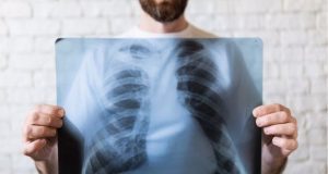 Καρκίνος του πνεύμονα: Αυτά είναι τα συμπτώματα
