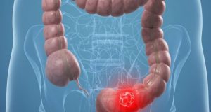 Καρκίνος πεπτικού συστήματος: Ποιος παράγοντας πολλαπλασιάζει τον κίνδυνο
