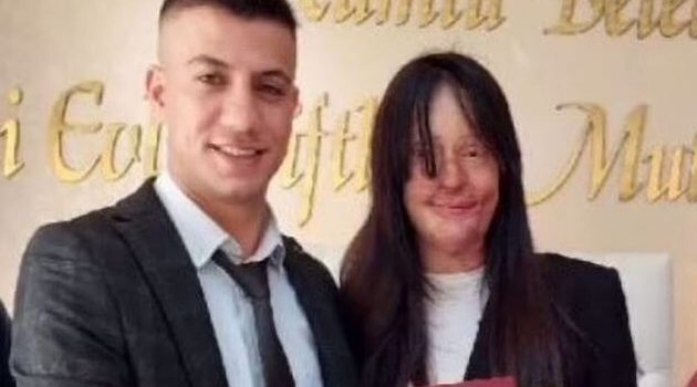 Γυναίκα στην Τουρκία παντρεύτηκε τον άνδρα που της έριξε οξύ στο πρόσωπο!