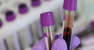 Νέο τεστ αίματος προβλέπει τον κίνδυνο εμφράγματος και εγκεφαλικού με…