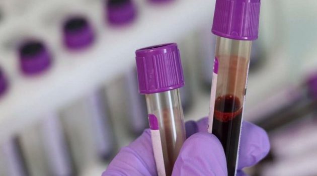 Νέο τεστ αίματος προβλέπει τον κίνδυνο εμφράγματος και εγκεφαλικού με αυξημένη ακρίβεια