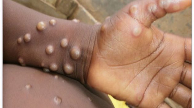 Τζανάκης για ευλογιά των πιθήκων: «Τελείως διαφορετική νόσος από την παιδική ανεμοβλογιά»