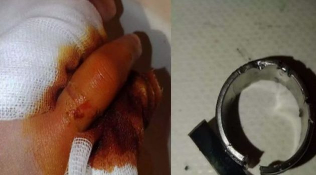 Βόλος: Έπαθε αιμάτωμα από το ατσάλινο δαχτυλίδι που σφήνωσε