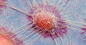 ΗΠΑ: Επιστήμονες κατέστρεψαν το 99% των καρκινικών κυττάρων στο εργαστήριο