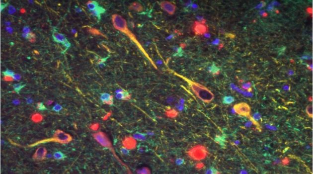 Μελέτη συνδέει το βακτήριο της νόσου των ουλών με το Αλτσχάιμερ