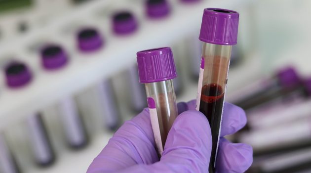 Αλτσχάιμερ: Νέα εξέταση αίματος θα μπορούσε να φέρει επανάσταση στη διάγνωση της νόσου