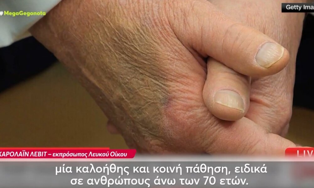 Ο Ντόναλντ Τραμπ πάθει από χρόνια φλεβική ανεπάρκεια, όπως ανακοίνωσε και ο Λευκός Οίκος δίνοντας επιλέον εξηγήσεις.